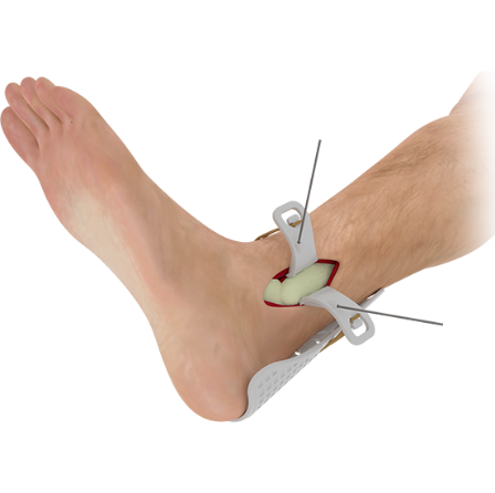 Ankle Ortho Final 01